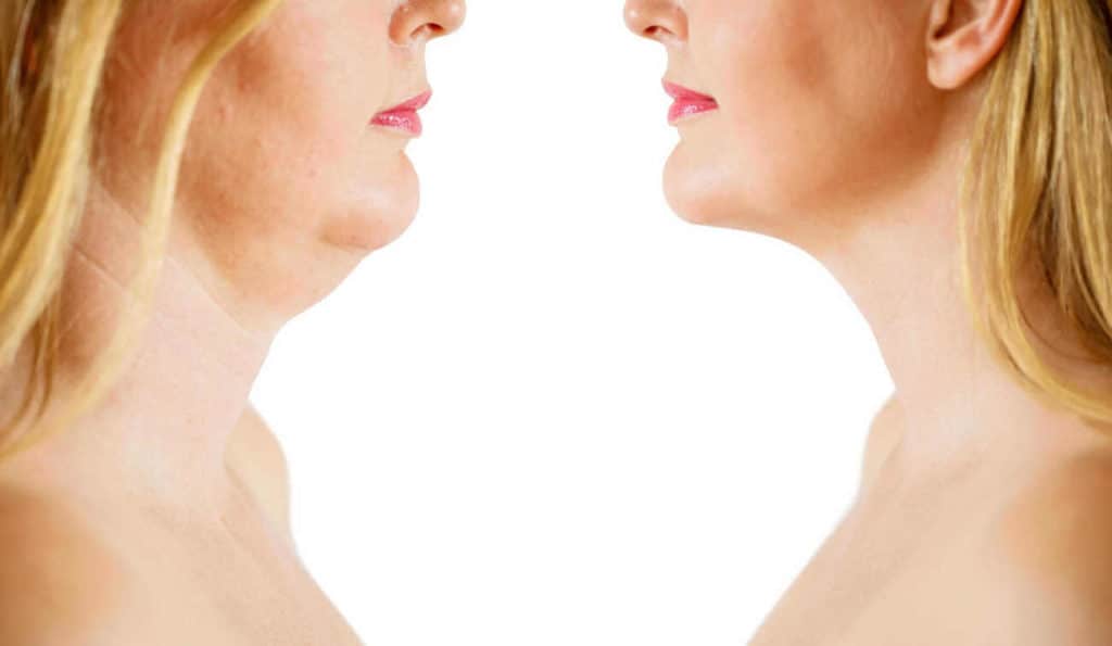Double Chin treatment Chesham before and after results