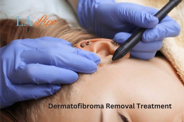 Dermatofibroma Removal Treatment Chesham