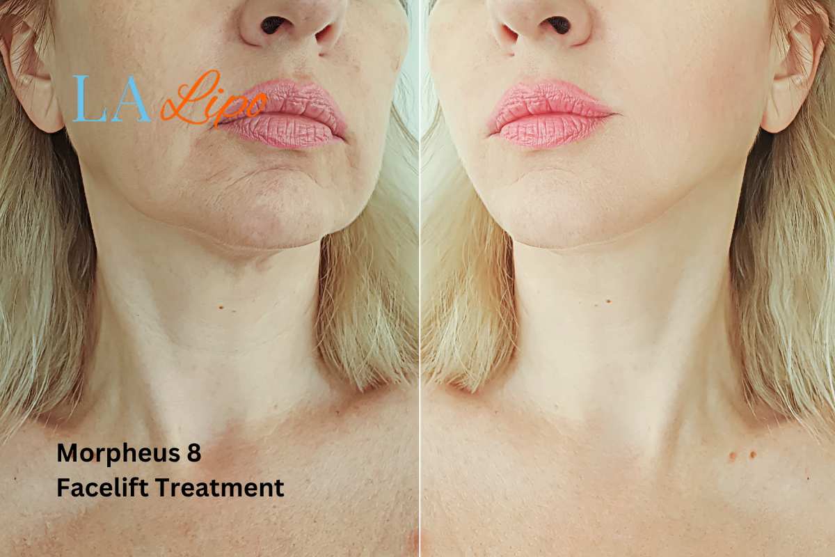 Turn back time with Morpheus8 Treatment Chesham