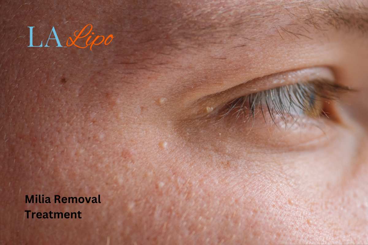 Cryopen Milia Removal: Is It the Easiest and Safest Option Chesham?