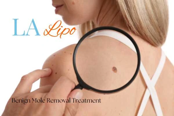 Why getting moles removed Chesham can boost your confidence!