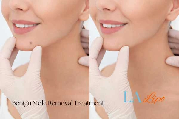 woman's before and after mole removal Chesham results