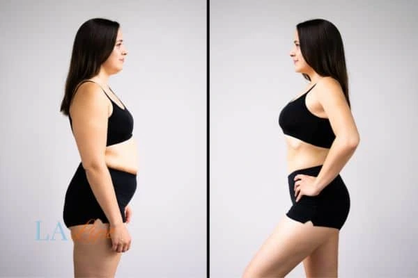 LA-EMS Body Sculpting Chesham results before and after of womans results on body toning.