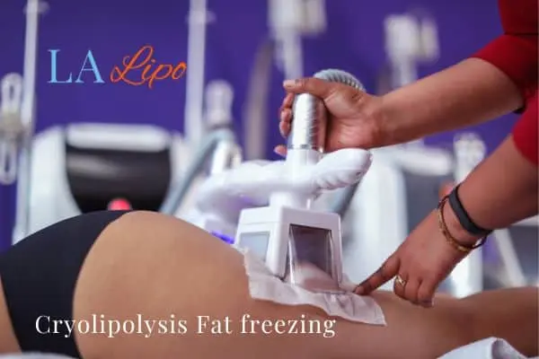 women getting fat freezing Chesham