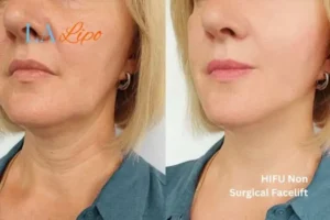 hi-fu for wrinkles Chesham before and after results