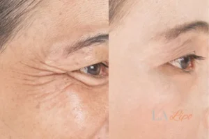 Before and after results of woman - HI-fu wrinkles reduction treatment Chesham