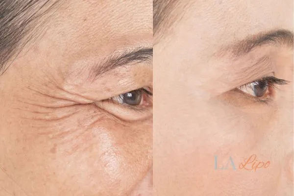 Before and after results of woman - HI-fu wrinkles reduction treatment Chesham