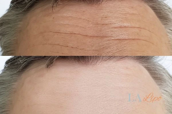 results of HIFU Chesham on mans forehead to help reduce lines and wrinkles