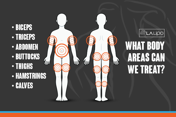 Graphic to show areas you can have LA-EMS Body Sculpting Chesham treatment.