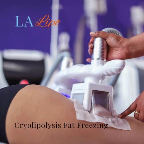 fat freezing - Cryolipolysis Chesham
