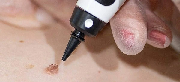 skin tag removal using cryopen Chesham
