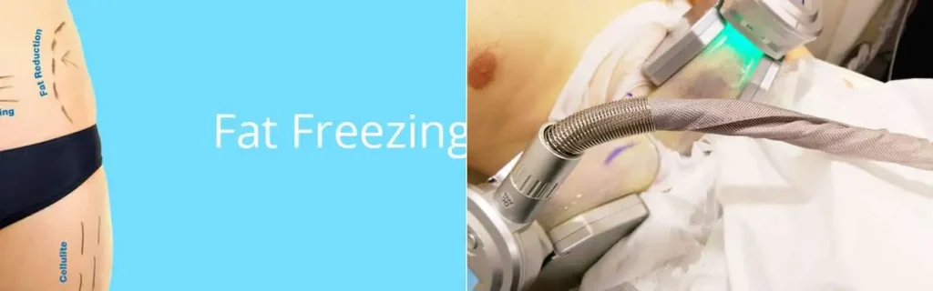 multi areas of a persons body having coolsculpting Chesham treatment