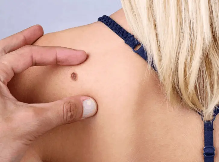 woman having mole removal Chesham consultation before treatment.