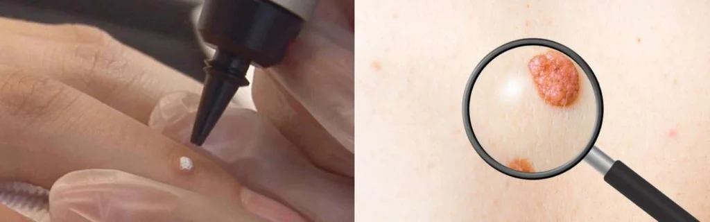 Person getting moles removed with cryopen Chesham
