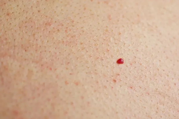 close up of a cherry angioma Chesham