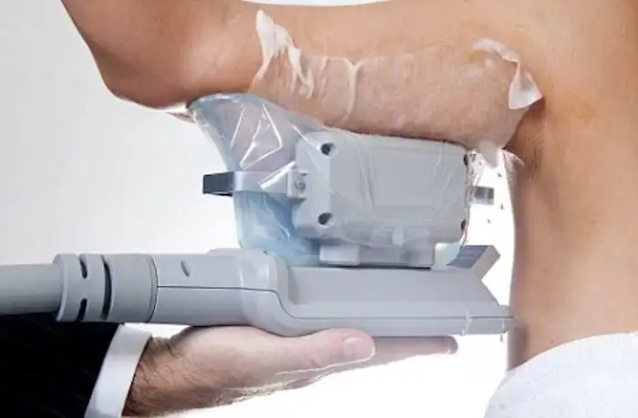 Picture of fat freezing Chesham on the upper arms.