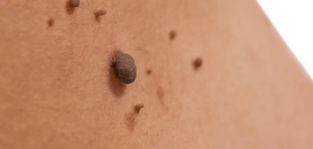 image of a skin tag Chesham