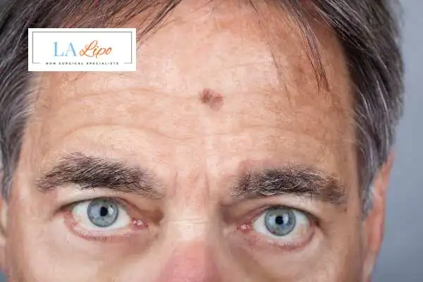 Solar Lentigo Removal Chesham image of man with mark on his forehead