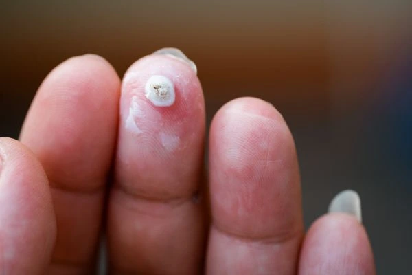wart on person finger - cryotherapy to treat from LA LIPO Chesham