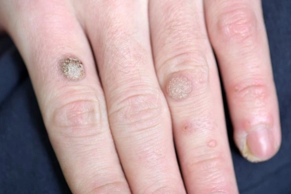 photo of warts on person hand - see wart removal Chesham from LA LIPO
