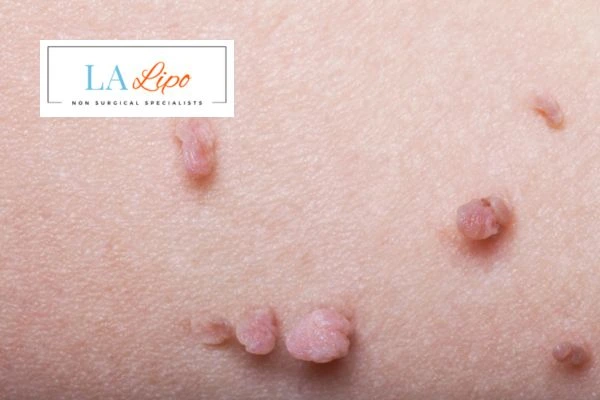 Does cryopen skin tag removal Chesham hurt? Find out now call our team today!