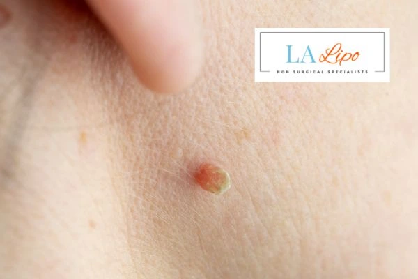 Book skin tag removal Chesham today speak to our team now!