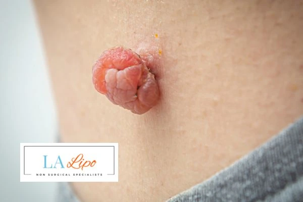 Interested in skin tag removal Chesham? Concerned about the pain? Find out more today!