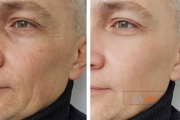 See the amazing results of Morpheus8 Treatment Chesham!