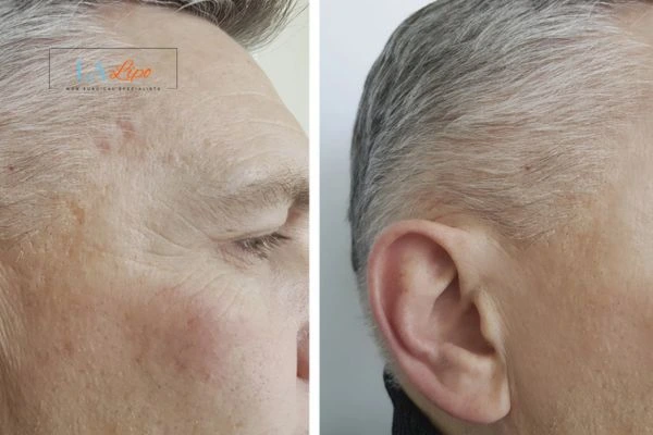 Mens Before & After Morpheus 8 Results Chesham