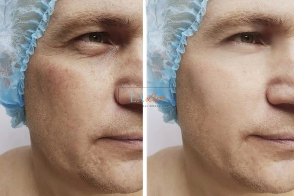 Before and after Morpheus 8 Results Chesham