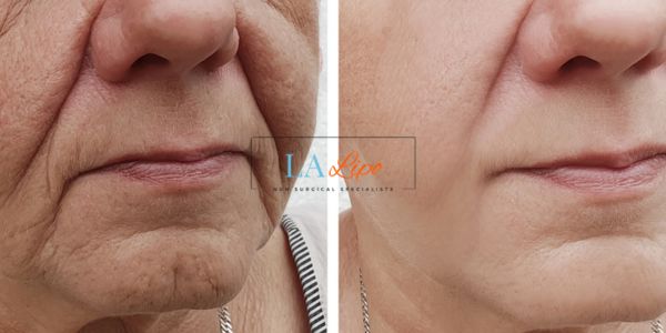 Older lady deeper wrinkle reduction - LA LIPO Morpheus 8 Results Chesham