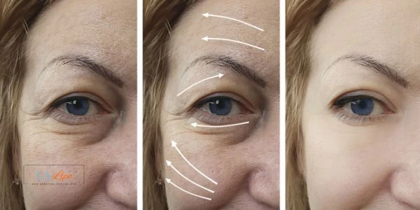 Amazing eye lift Morpheus 8 results Chesham