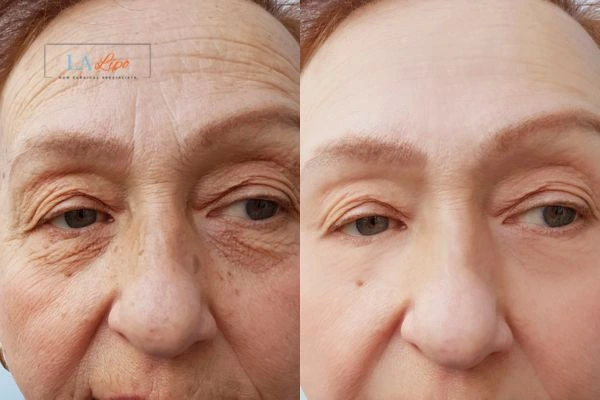 The powerful benefits of Morpheus8 Treatment Chesham - Call Our team today!
