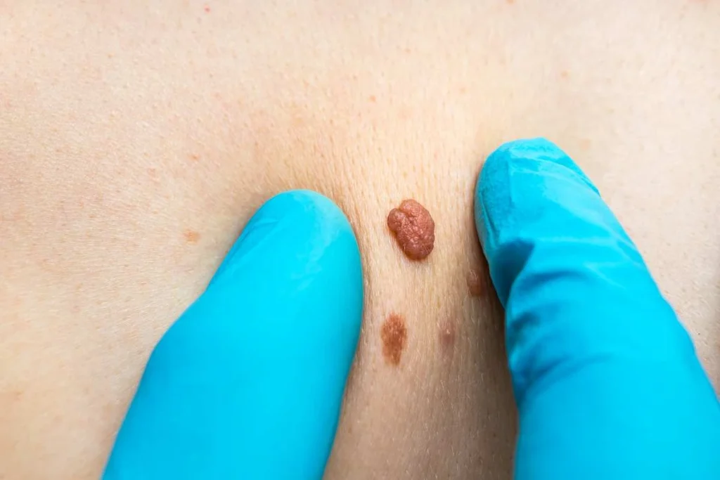 LA LIPO Cryopen Lesion Removal Prices Chesham