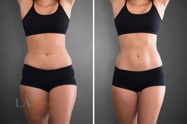 before and after results of non-surgical treatment to help a woman's body image and mental health Chesham