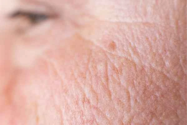 close up picture of a woman's face showing an age spot Chesham