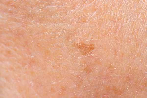 close up picture of age spots Chesham