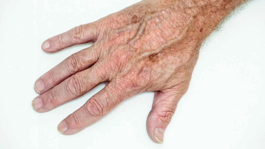 Male hand showing age spot Chesham