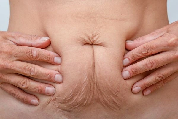 Image of a woman's stomach with loose skin - example of skin tightening Chesham options