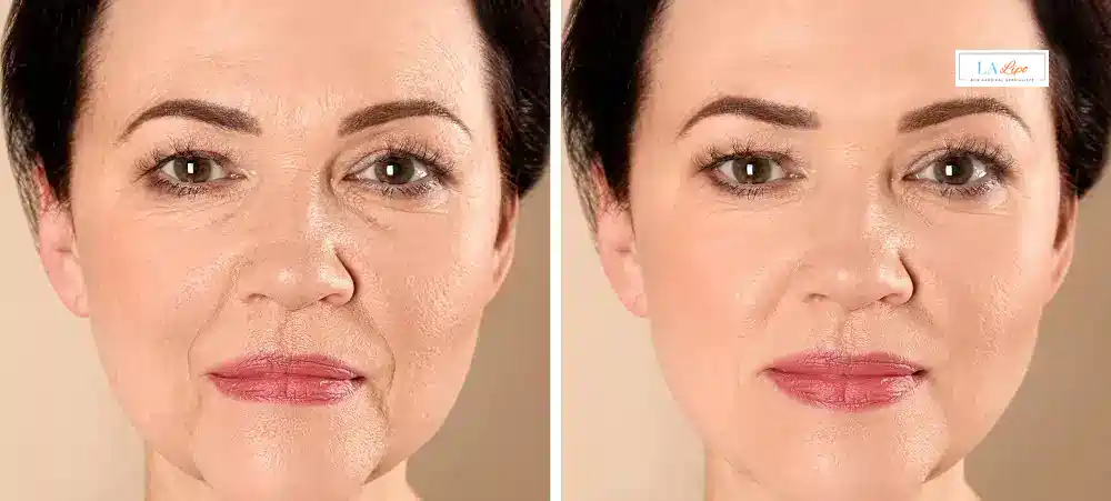 How Long Does It Take to See Results and How Long Do They Last Chesham?