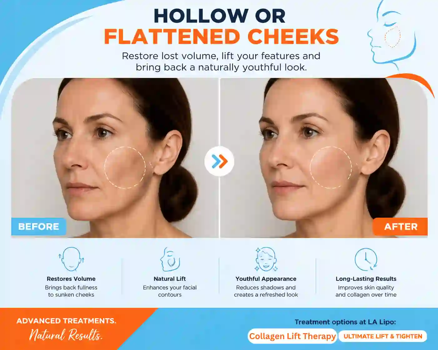 Sign #4: Hollow or Flattened Cheeks Chesham