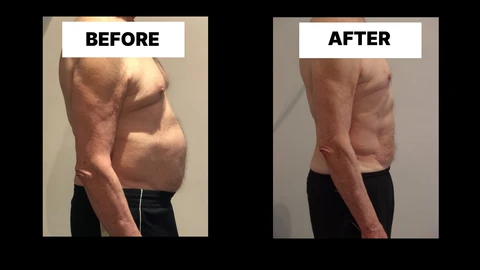 What Symptoms Can Diastasis Recti Cause in Men? Weak Core, Back Pain and Poor Posture Chesham
